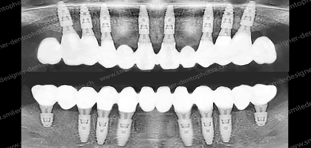 solution implants oneshot avec mci