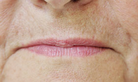 dvo-assechement-levres