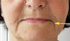 dvo-ecrasement-levres