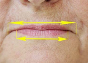 dvo-retrecissement-levres