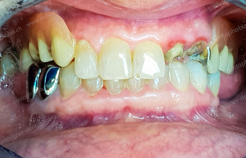 photo-bridge2-before