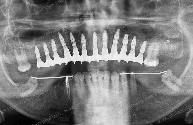 bridge-resilent-radio-after-4