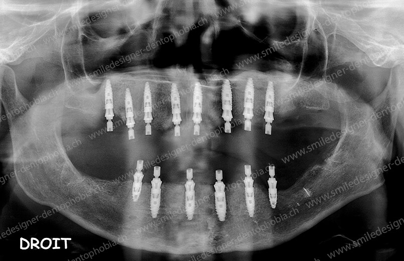 domino-radio-after-2