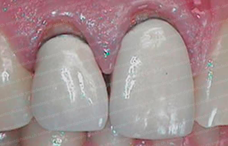 red-flag-couronne-before