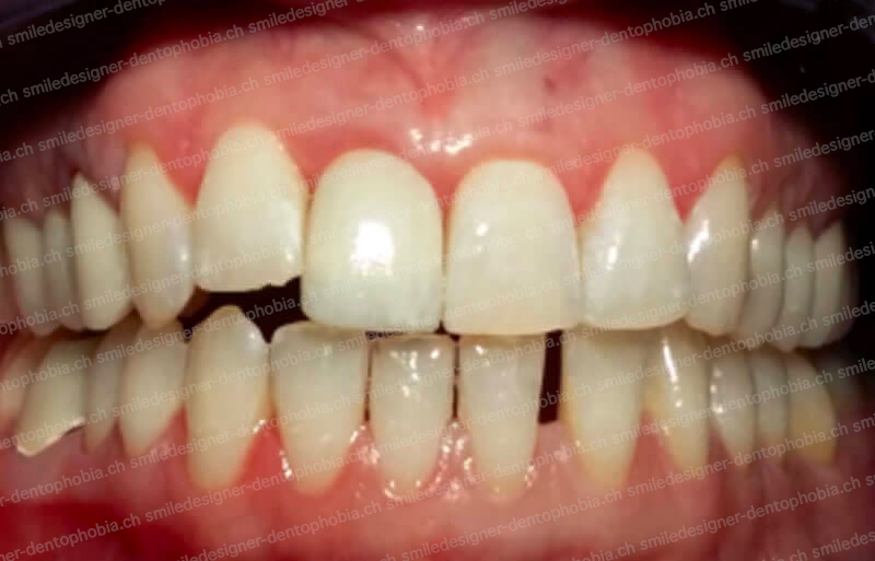 red-flag-implant-after-2