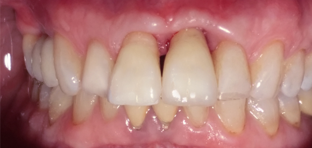 red-flag-implant-after-3