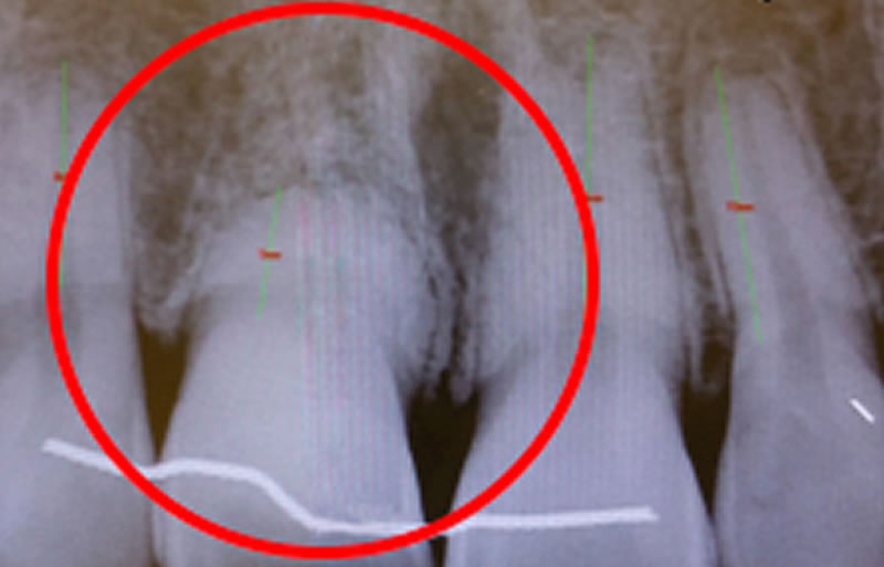 red-flag-implant-before-1