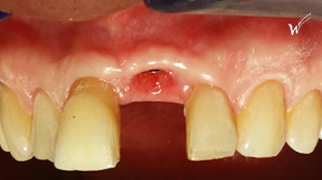 red-flag-implant-before-3