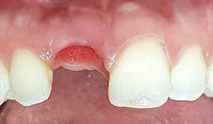 red-flag-implant-middle