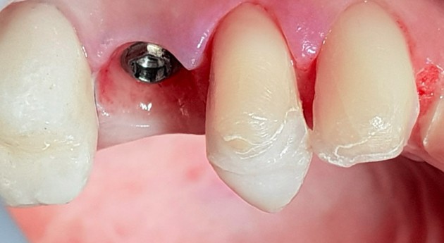 Détail de l’implant dentaire à droite