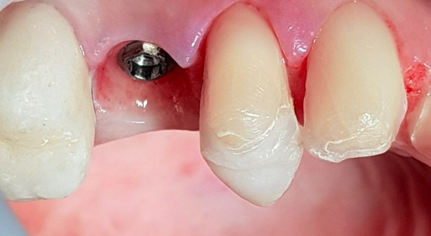 Détail de l’implant dentaire à droite