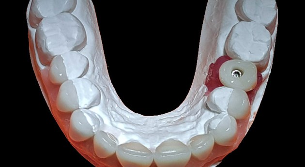Facettes et couronne sur implant sur le modèle